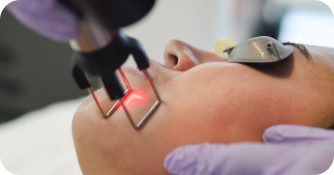CoolPeel laser resurfacing in Spring, TX