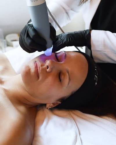 Exion RF Microneedling skin tightening in Spring, TX